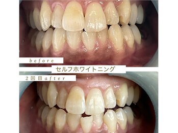 エスデザイン(es design)/セルフホワイトニング/鹿児島