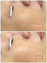 FJ/ほうれい線◎