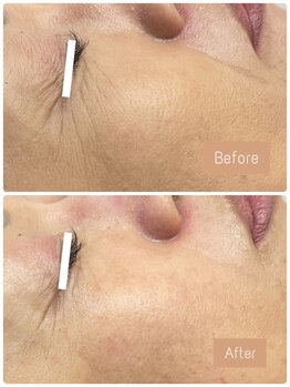 FJ/ほうれい線◎