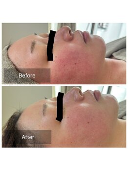 ソルーチェ(soluce)/スッキリ美白コース