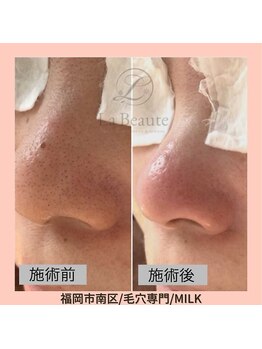 ミルク(MILK)/隠しきれない小鼻の黒ずみ解消♪