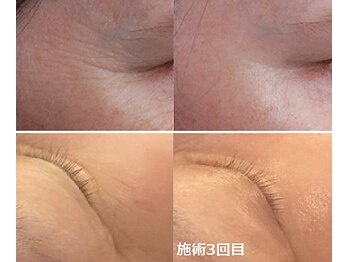 ナチュレアンドメディカ(Nature&Medica)/顔脱毛+小じわケアフェイシャル