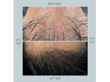 エクソリフトは毛の減少・白髪・分け目の薄さにも期待大！