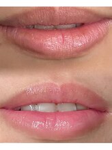 ヨウン 大阪心斎橋(yeoun)/ローマピンク大阪/メラニンケア