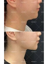 ナラビューティー(NARA BEAUTY)/韓国最新オンタリフト導入！