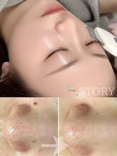 ストーリー(STORY) 毛穴ケア 毛穴洗浄