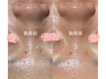 ストーリー(STORY)/眉毛と艶肌ワックス専門店