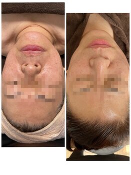 ル リール(Le rire)の写真/本来の状態を取り戻す！たるまない美顔根本から改善へ導く集中ケアで輝く毎日を☆