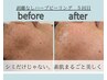 【￥11550】年齢肌、荒れやすく赤みが出やすい敏感・乾燥肌にオススメ！