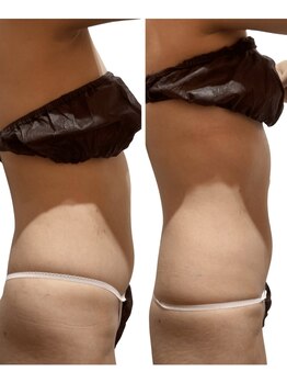 痩せラボ/ぽっこりお肉を改善【痩身】