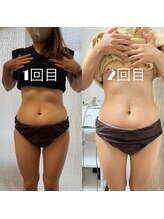 リリーボーテ 下北沢/インディバ施術（お腹）