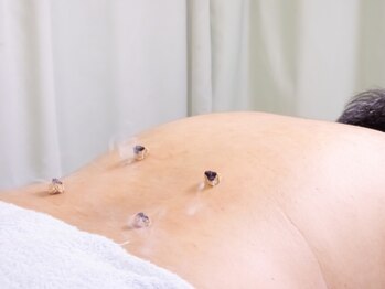 湧成堂鍼灸整骨院/お灸施術