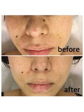 アトレ(Atre)/光フォト美顔でキレイに♪