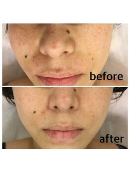 アトレ(Atre)/光フォト美顔でキレイに♪