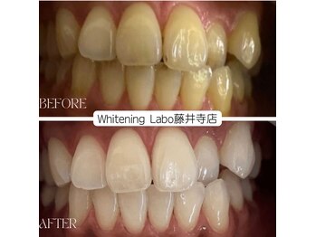 ホワイトニングラボ(Whitening Labo)