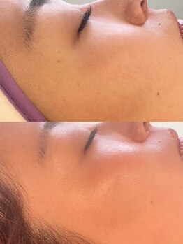 エムブロウ 福岡天神店(M brow)の写真/【眉毛+顔脱毛】眉毛専門店だからこそ◎美眉とつるん肌が同時に叶う！眉毛WAX+顔脱毛(ワックス脱毛)¥8400～