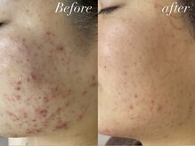 レシェルサロン(Lechelle Salon)/ハーブピーリング＋オプション