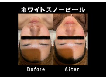 エステティック レイビス 銀座店(RAYVIS)/顔脱毛×ホワイトスノーピール