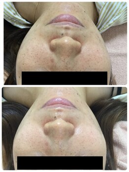 メイユール(MEILLEUR)/光フェイシャル1回+スキンケア