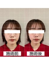 ヴィーライン 大阪梅田院(VeLine)/鍼灸／美容鍼／小顔／大阪／梅田