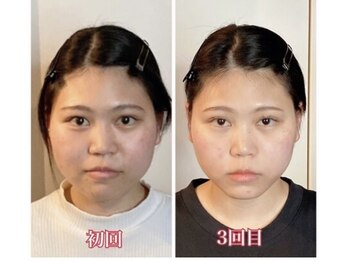 小顔22 ボルティ 本店(Bolty)/20代:小顔シンメトリー(3回)