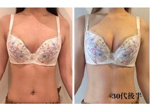 リール 新宿店(RIRE)/30代後半　バストアップ症例