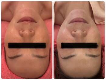 サロンドデュイ/1回施術/40代