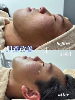 メンズ脱毛サロンKurozukin 　赤坂店の写真/《メンズもフェイシャルケアする時代*》毛穴・ニキビケア&速効性◎オリジナルハーブピーリングで肌質改善★