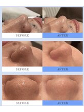 ホワイトアクア 京橋店(WHITE AQUA)/毛穴洗浄×引き締め 1回目