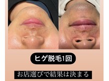 モデルズ 名古屋(MODELS)の雰囲気（#ヒゲ脱毛＃矢場町ヒゲ脱毛＃名古屋ヒゲ脱毛＃栄ヒゲ脱毛）