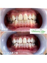 ホワイトニングサロン 名古屋駅店/【ホワイトニング施術例】