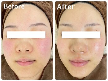 フェイシャルエステ エムズルーム(M's room)/リフトアップ！すっきり小顔に♪