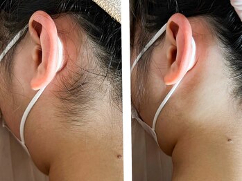 ウルオイ 海老名(URUoi)/脱毛Before→After