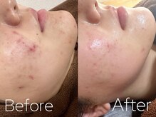 バーニー 梅田店(BARNEY)/ハーブピーリング