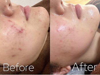 バーニー 梅田店(BARNEY)/ハーブピーリング