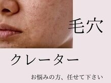 ヒール(heal)