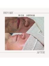 エンルーチェ プラスエイト(en;Luce+8)/ヒゲ脱毛2回目　