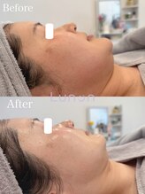 ルノン(Lunon)/毛穴洗浄ハイドロ×ララピール