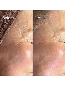 ステラティエ(Stellatier)の写真/未来の肌へ導くプラズマ!シミシワにアプローチし、ハリツヤ肌へ。若々しい印象を目指しませんか?