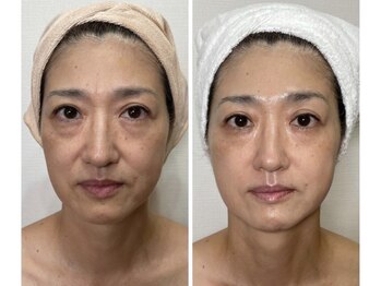 ソレイユ(soleil)/陶肌トリートメント