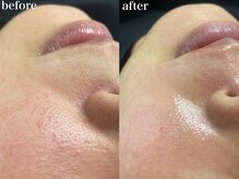 スリー(THREE)/都度払い脱毛【THREE】