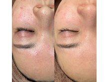 シエル ブルー(Ciel Blue)/肌質改善　韓国肌管理