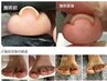 Foot巻き爪ケア　フラットケアジェル　1本お値段
