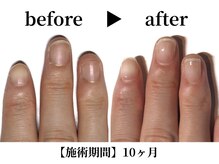 リング ザ ベル(ring the bell)/深爪スタンダードコース¥11,000