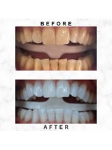 エミリアホワイトニング(EMIRIA WHITENING)/Before/After