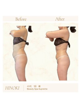 シュプレーム(Supreme)/ヒノキ/自律神経・免疫/首/肩