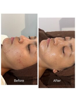 デイジー/ニキビケアならデイジー！！