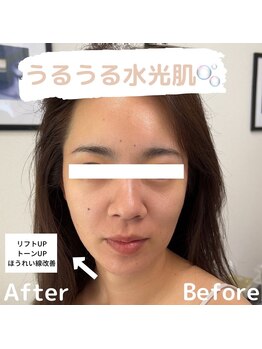 ラ フルール(La Fleur)/水光ジェット エアバリ