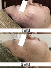 サロンドジェシカ(salon de Jessica)/ハーブピーリング