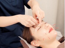 からだ元気整体院 初台南口院の雰囲気（美容鍼にて小顔・眼精疲労などに効果的です。）